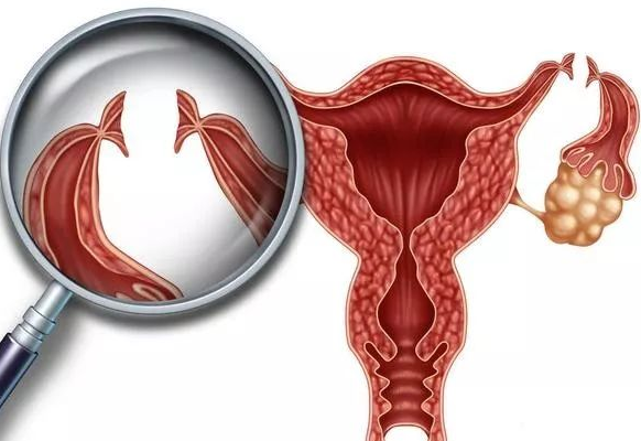 深圳女性卵巢囊肿有哪些需要注意的